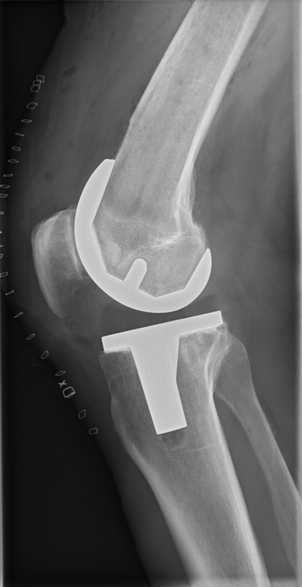 Röntgenbild eines menschlichen Beins mit einem Kniebruch und sichtbaren Ligamentverletzungen.
