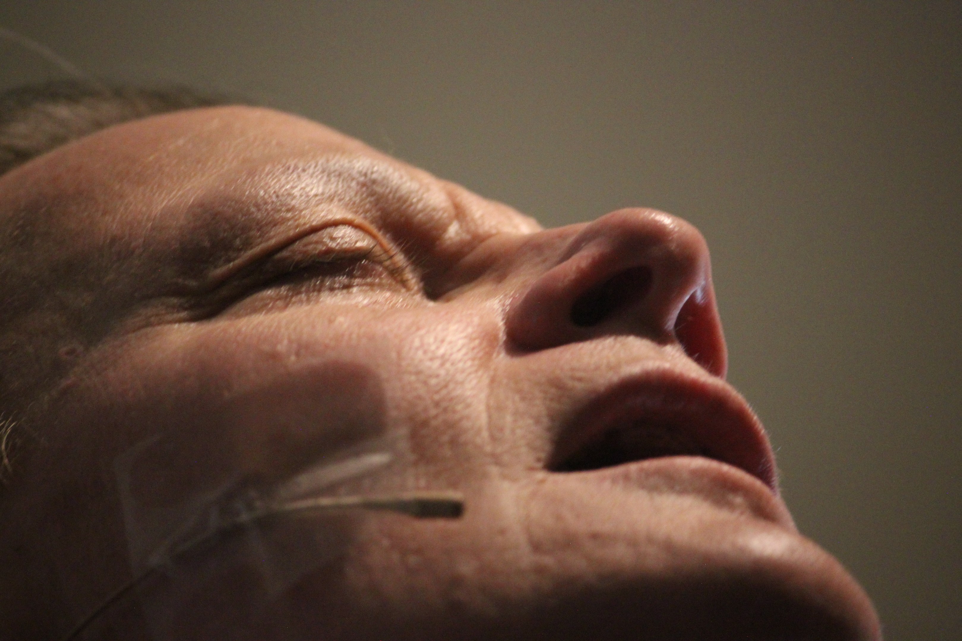 Nahaufnahme eines Frauengesichts während einer Behandlung mit Nadeln in der Nase, Augen geschlossen, vor einer neutralen Wand.